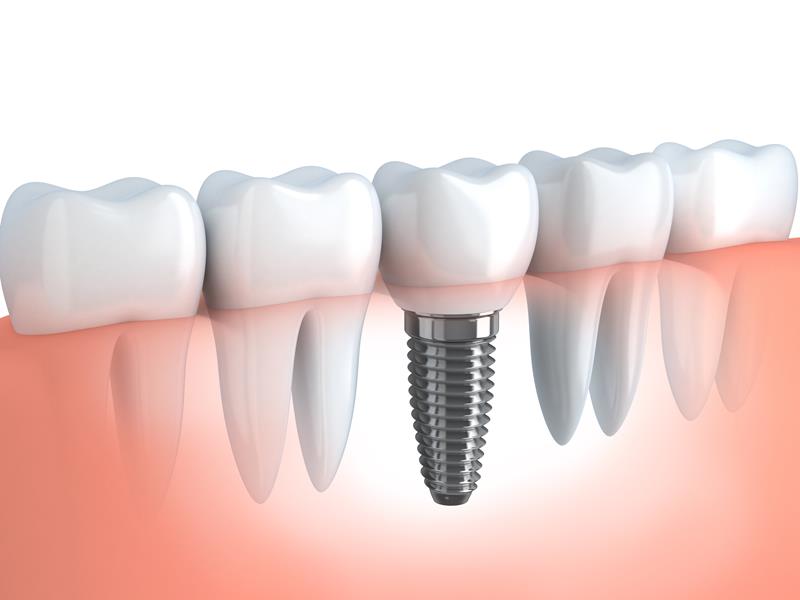 Dental Implants in San Lorenzo
